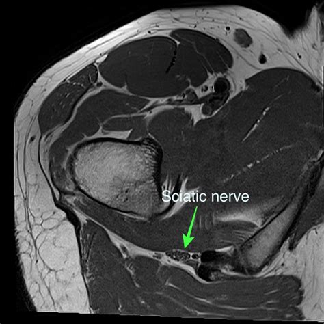 mri scan for sciatic nerves